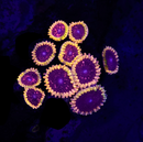 JF Acid Reflux - 1 Polyp